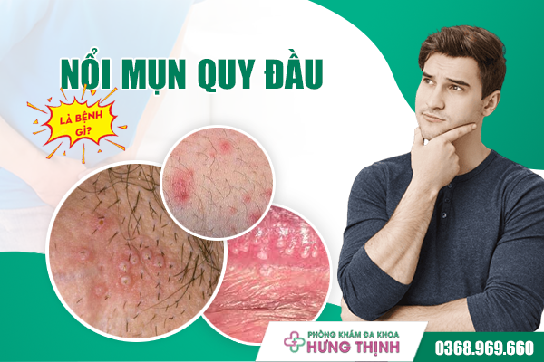 Nổi Mụn Quy Đầu Là Bệnh Gì? Gợi Ý Giải Pháp Điều Trị Hiệu Quả, An Toàn