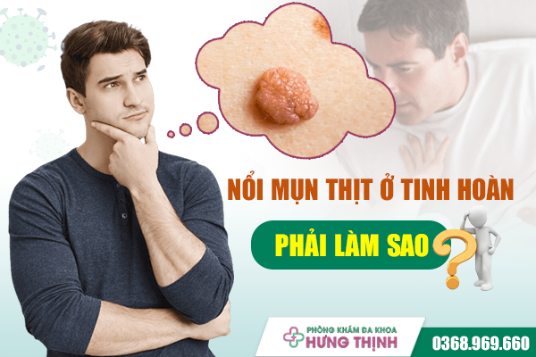  Nổi Mụn Thịt Ở Tinh Hoàn Phải Làm Sao? Chia Sẻ Kinh Nghiệm Điều Trị Thành Công