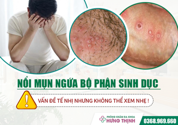 Nổi mụn ngứa ở bộ phận sinh dục: Vấn đề tế nhị nhưng không thể xem nhẹ 