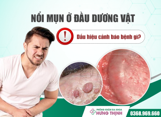 Nổi mụn ở đầu dương vật - Dấu hiệu cảnh báo bệnh gì?