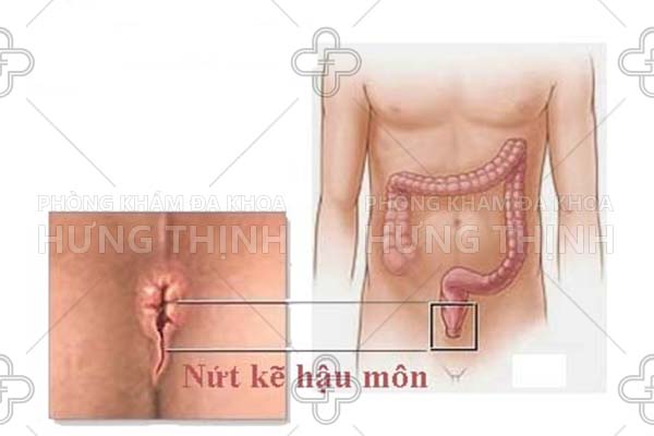 Tác hại của nứt hậu môn là gì