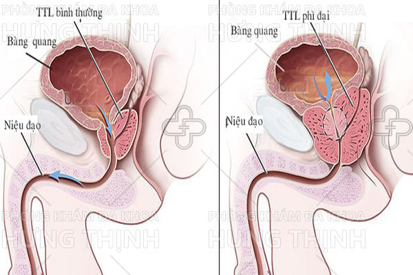 Điểm qua cách chữa bệnh phì đại tuyến tiền liệt