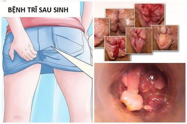 Bệnh trĩ sau sinh: Nguyên nhân, triệu chứng và biện pháp điều trị