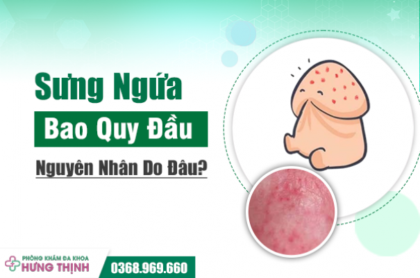 Sưng Ngứa Bao Quy Đầu Nguyên Nhân Do Đâu? Bí Kíp Điều Trị Hiệu Quả, Đơn Giản