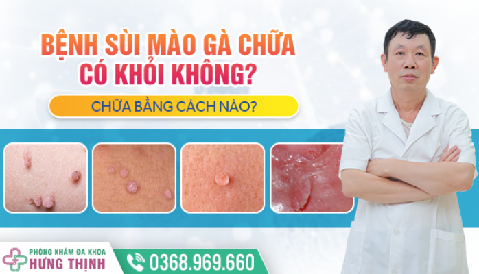  Bệnh Sùi Mào Gà Chữa Có Khỏi Không? Chữa Bằng Cách Nào?