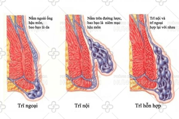 Cắt trĩ bằng phương pháp an toàn hiệu quả