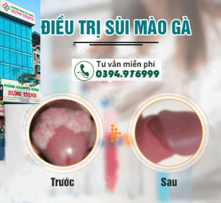 Phương pháp xét nghiệm bệnh sùi mào gà đạt chuẩn