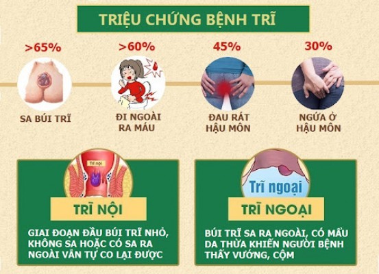 Sa búi trĩ hay búi trĩ sa ra ngoài - Biến chứng nguy hiểm của bệnh trĩ