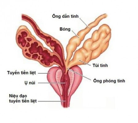 Viêm nhiễm túi tinh có gây vô sinh không? Đi tìm cách điều trị an toàn, hiệu quả