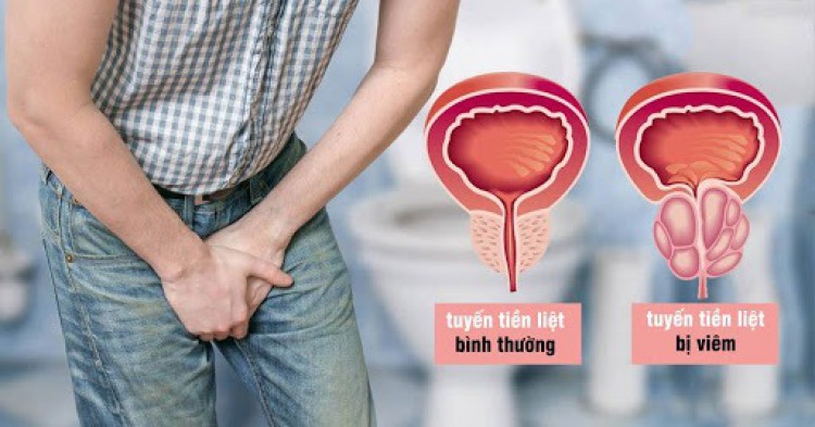 Tìm hiểu về bệnh viêm tuyến tiền liệt