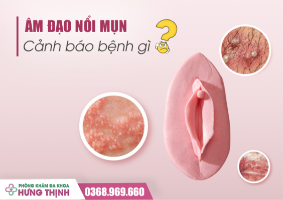  Âm Đạo Bị Nổi Mụn Cảnh Báo Bệnh Gì?