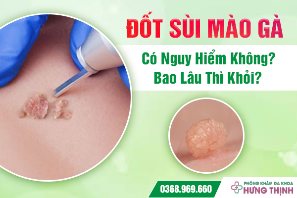 Đốt Sùi Mào Gà Có Nguy Hiểm Không? Bao Lâu Thì Khỏi?